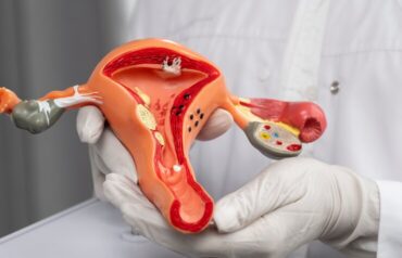 Adenomyosis-Treatment
